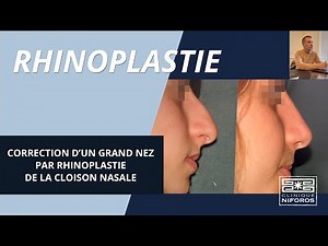 Correction d'un grand nez par rhinoplastie de la cloison nasale - Dr Niforos à Lyon