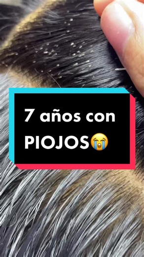 7 Años con Piojos: Descubre Cómo Se Ven los Piojos en la Cabeza