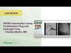 PAVM Embolization Using Combination Plug and Hydrogel Coils - Charles Martin, MD | Terumo Interventi
