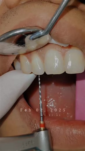 Understanding Root Canal Treatment for Front Teeth