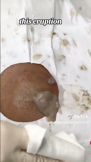 CYSTS EXPLODES LIKE A VOLCANO!!! #cystspoppingthisweek #cysts #cyst