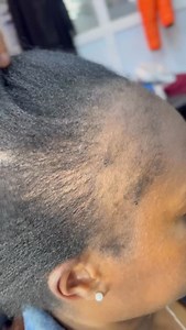 SCALP ANALYSIS & CONSULTATION -2500ksh Jet peel scalp cleanse - 3500ksh Jet peel scalp cleanse 4 sessions 2500 per session HAIR PRP TREATMENT -15000ksh Head spa services in ,Eldoret kenya 📩 Book appointments ☎️Call 0710472946 DM/Text Prp treatment in Eldoret , Hair transplant in Eldoret , Massage .facials #jetpeelinkenya #eldoret #salonseldoret #kjsalon #trichologistineldoret | KJ SALON KENYA