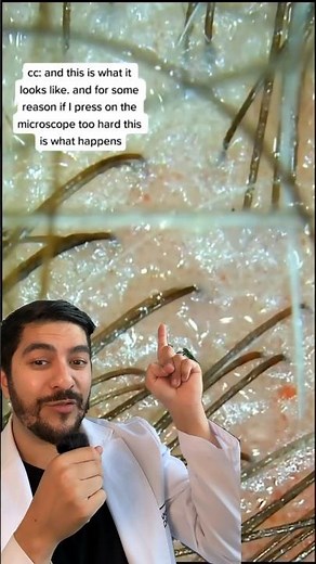 Dandruff Under A Microscope 🤯