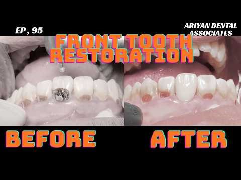 Front Tooth Restoration: The Procedure Everybody Wants !!!