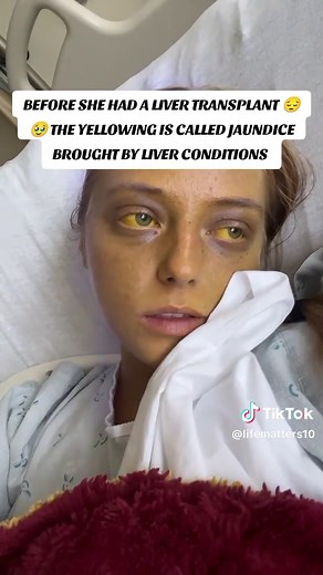 Liver Transplant Journey: Before and After Transformation