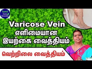 Varicose Veins Treatment in Tamil - Varicose Veins Siddha Treatment - Varicose Veins Home Remedies