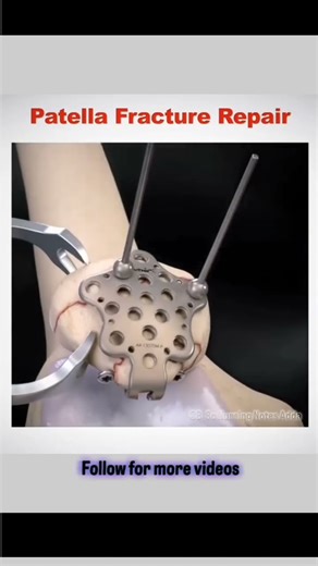 pattel fracture repair #👩🏻‍⚕️physiotherapist📝❤️ #trending #viralvideo 👩🏻‍⚕️❣️📝