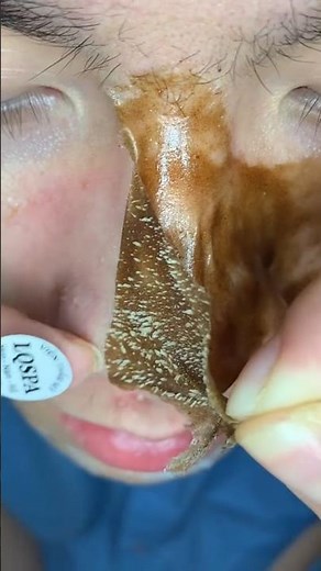 Deep Nose Blackhead Removal 😱 | Super Satisfying Skin Cleaning