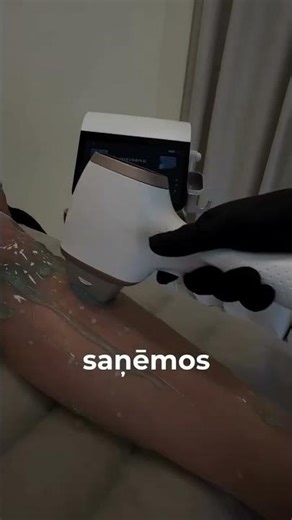 Aleksandrīta lāzers izrādījās daudz komfortablāks, nekā gaidīju