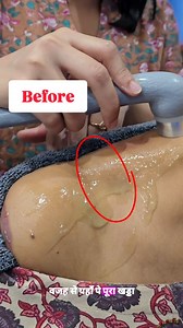 That deep shoulder pain? ❌ Not gym ❌ Not sleeping wrong ⚠️ Tight bra straps = silent pain trigger Before ➡️ After Relief is possible 🙌 | Kiva Rehab