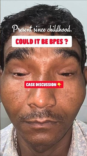 Blepharophimosis Ptosis Epicanthus Inversus Syndrome (BPES)