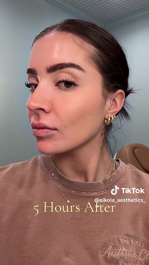 Dissolving Lip Filler with Hylenex: My Healing Journey