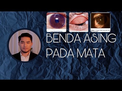 BENDA ASING DI PERMUKAAN MATA (KELILIPAN) - Solehudin Widya Putra EduKes