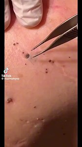 Excavation of the thick blackheads, pure soothing relaxation. ASMR satisfaction 😅✨ 🔶🔶