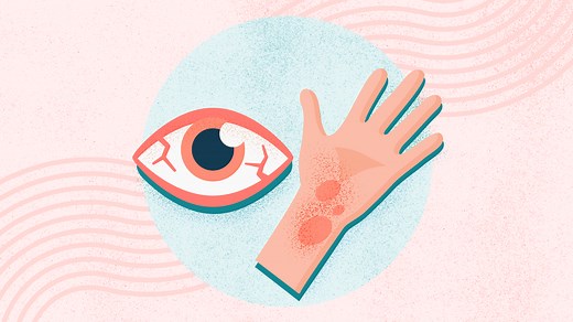 What Are Allergies? Symptoms, Causes, Diagnosis, Treatment, and Prevention