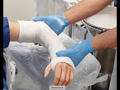 How to apply an above elbow backslab - Orthocycle Foundation