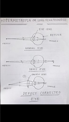 Hypermetropia Ray Diagram | Easy Eye Defect Drawing for Exams (Class 10 & 12 Physics)