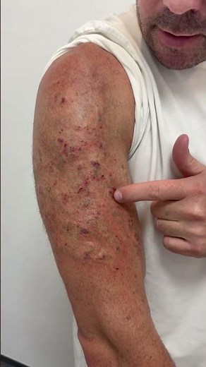 Laser Tattoo Removal Aftercare & Complication Prevention – Evidence-Based Patient Guide (AHPRA)