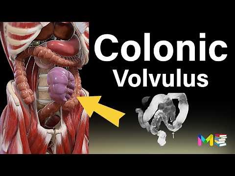 COLONIC VOLVULUS (Types, Causes & Symptoms Of Volvulus)