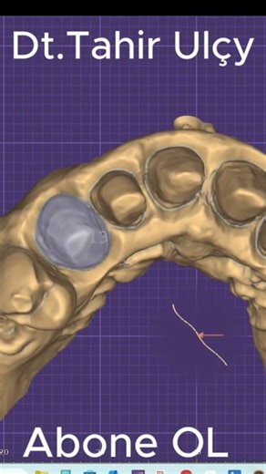 Exocad Offset metal tasarım nasıl yapılır...