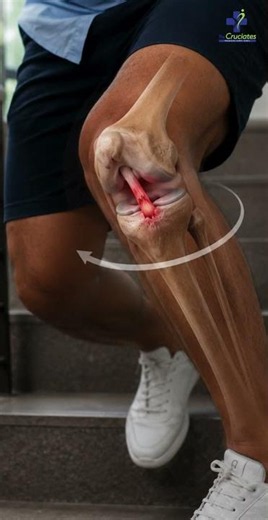 MRI Normal... Fir Bhi ACL Tear Ho Sakta Hai? 😳| ACL Recovery | Ligament Surgery