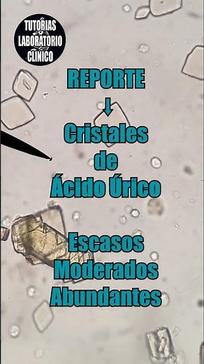 🪨Cristales que DESTRUYEN tus Riñones ¿Que son y que Significa los cristales de ÁCIDO ÚRICO en Orina?