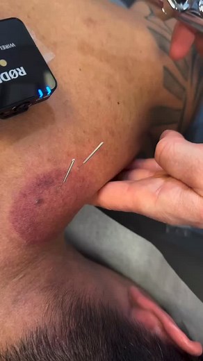 🏆 Dry needling stimulates a local twitch response—an involuntary contraction that helps release tight muscle fibers and restore normal tone. It also increases blood flow and decreases chemical irritation in the tissue. 🏋🏾‍♂️🏃🏼‍♀️🏌🏽‍♂️ #DryNeedling #TriggerPointTherapy #ChicagoChiropractor | Dr_kyleross