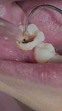 Extreme Tartar Removal ASMR | Deep Teeth Cleaning & Yellow Teeth Transformation