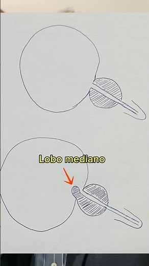Median lobe is the biggest problem of enlarged prostate #enlargedprostate #prostatichyperplasia