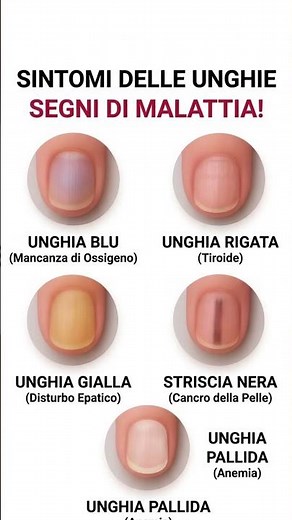 Sintomi delle unghie: segni di malattia da non ignorare #unghie #salute #sintomi #diagnosi #tiroide