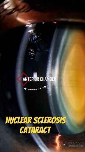 🔍 Layers of Cataract Revealed! | Nuclear Sclerosis under Slit Lamp ✨👁️ #clinical #ophthalmology
