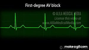 Atrioventricular Block (AV block) - Types of Heart Block Part 2, Animation. on Make a GIF