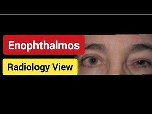 Enophthalmos - Causes - Radiology