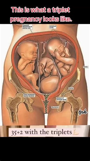 What Does a Triplet Pregnancy Look Like? Exploring Triplets in the Womb