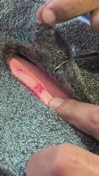 Figure of eight suturing for stopping bleeding.