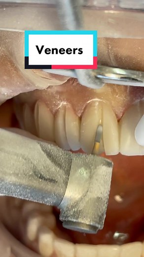 Lab Design and Customizing Veneers: A Step-by-Step Guide