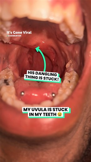 3.5M views · 10K reactions | It’s painful and I can’t get it out! | IGV | Facebook