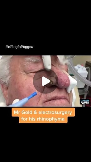 Sandra Lee, MD, FAAD, FAACS on Instagram: "A peak into how I treat rhinophyma on Mr Gold! Link in bio for more❤️ #rhinophyma #dermatology #drpimplepopper"