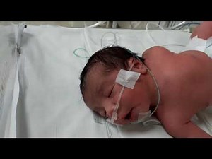 case 507syndifer syndrome, opisthotonic position,GERD,hital hernia ،aspiration pneumonia torticollis