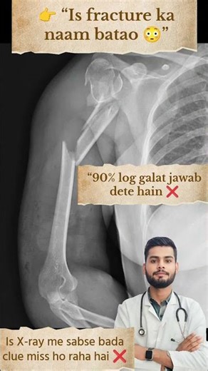 90% 😨🦴Log Galat Bolte Hain⚠️ ❌ | Bone Fracture X-Ray #shorts #physiotherapist #mbbs #fracture #ortho
