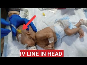 Scalp IV Line Insertion in Newborn | Safe Neonatal Procedure | NICU Care Tutorial #trending #baby