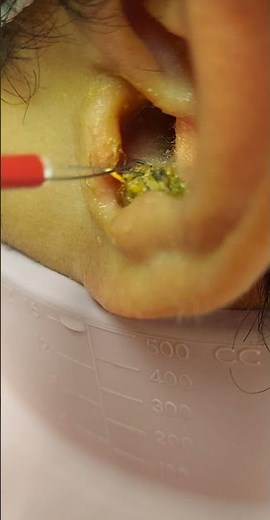 Ear wax removal (large chunk)