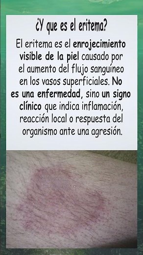 ¿Y qué es el eritema exactamente?