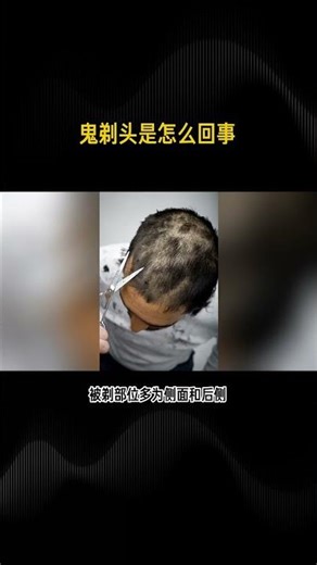 What is alopecia areata? #health #ChineseMedicine #EncyclopediaCode #SciencePopularization #Wellness