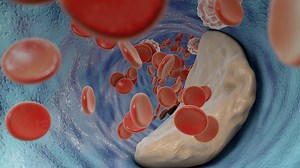 A Look at Lipoprotein(a): Key Screening & Treatment Strategies