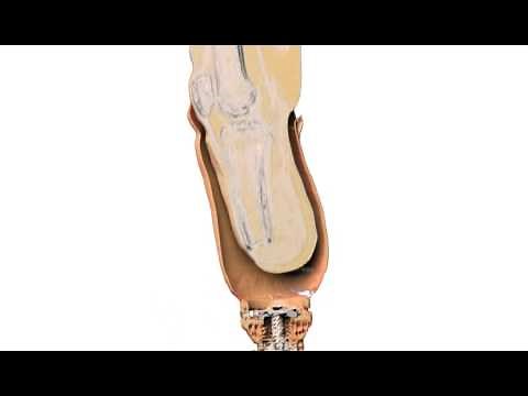 3D Amputated Leg & Prosthetic