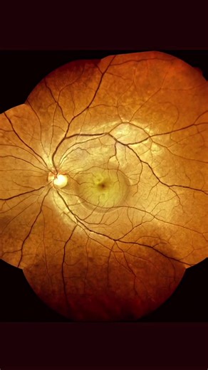 👁️Central Serous Retinopathy fundoscopic findings🕵️ #retina #ophthalmology #eyecare #eyehealth #ophthalmologist