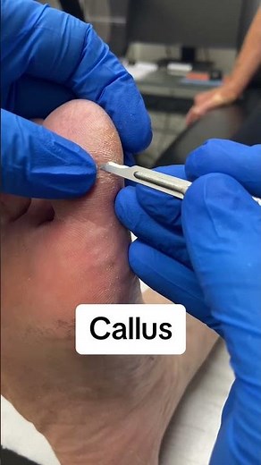 Big Toe Callus Removal: Expert Tips & Techniques #Podiatry #FootCare