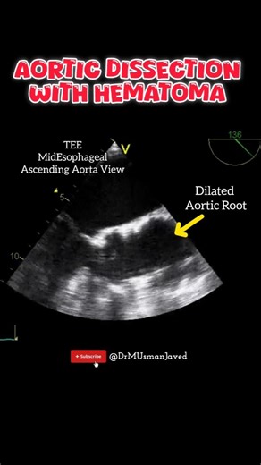 Aortic Dissection with Hematoma on Echo