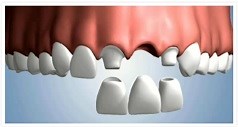 Bridge dentaire de qualité - New Dentaire